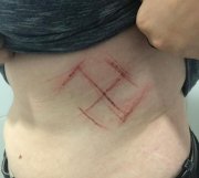 Jovem é agredida em RS e tem barriga marcada com símbolo nazista
